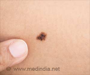 New Mechanism Involved in Early Melanoma Metastasis Discovered