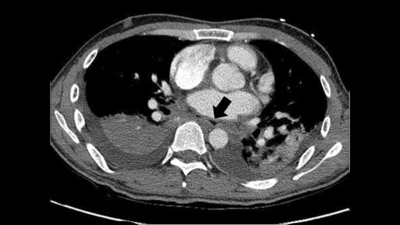 CT and Surgery Best Diagnose and Manage Esophageal Fistula