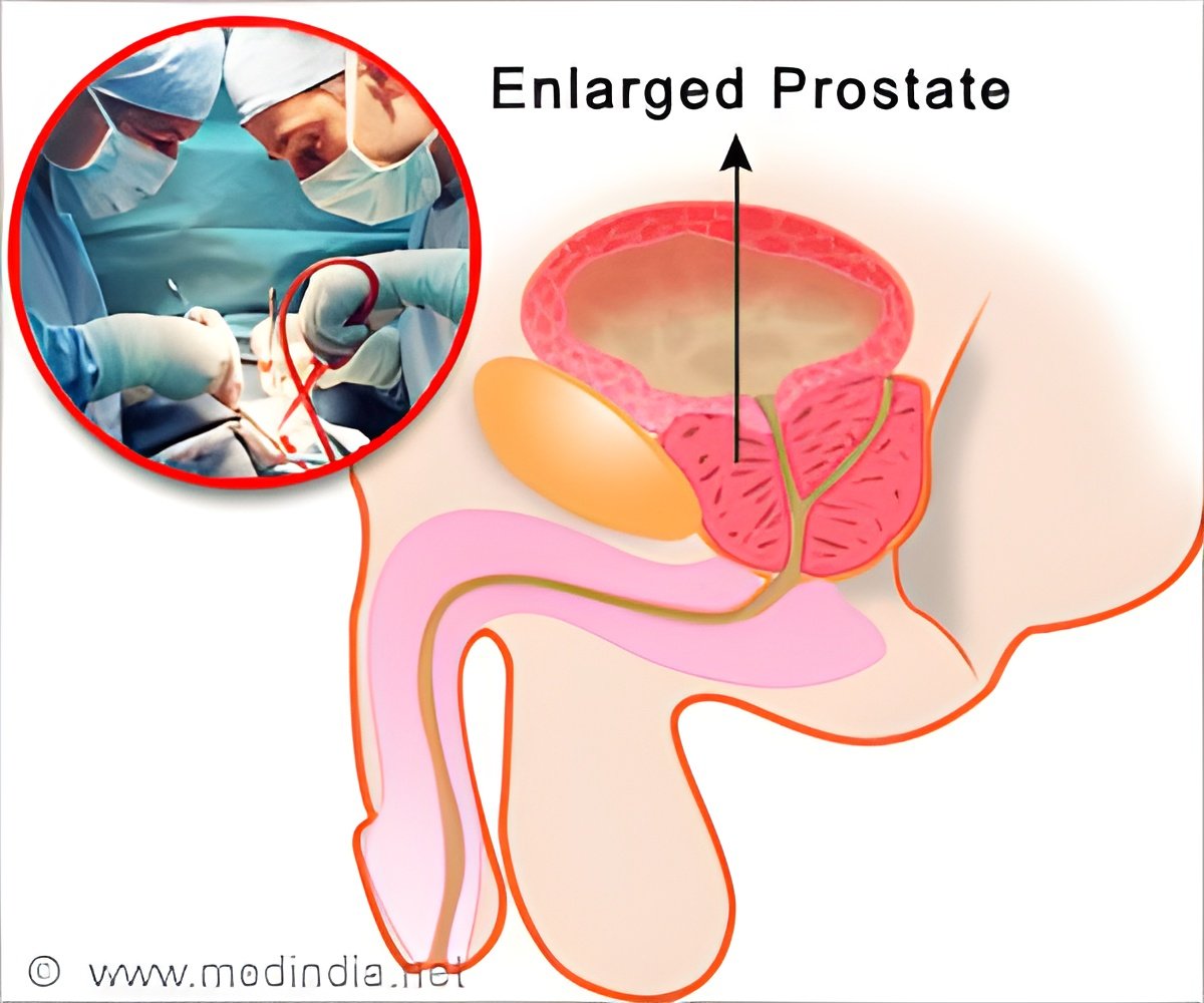 Treat Enlarged Prostate as Soon as Possible Before It Gets Worse